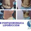 Paciente postquirurgica de liposucción resultados en 10 sesiones 