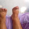 Tratamiento de edema.