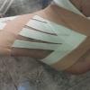 Kinesiotape en esguince de 2 grado