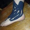 Kinesiotape drenaje hematoma